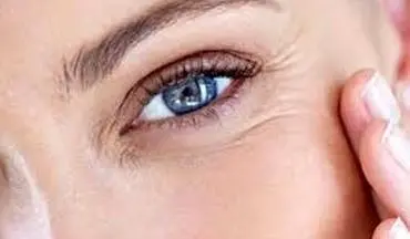 درمان خانگی چروک دور چشم| دیگه پول به داروهای گران نده!