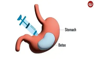 آیا بوتاکس معده می‌تواند مشکل چاقی را حل کند؟  این روش برای چه کسانی مناسب است؟ 