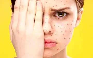 هرآنچه لازم است درباره آبله ‌مرغان و زونا در بارداری بدانید!