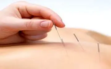 را‌ه‌های کنترل درمان ام‌اس با طب سوزنی