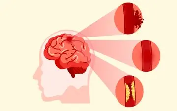  خواب نامنظم می‌تواند خطر حمله قلبی و سکته مغزی را افزایش دهد