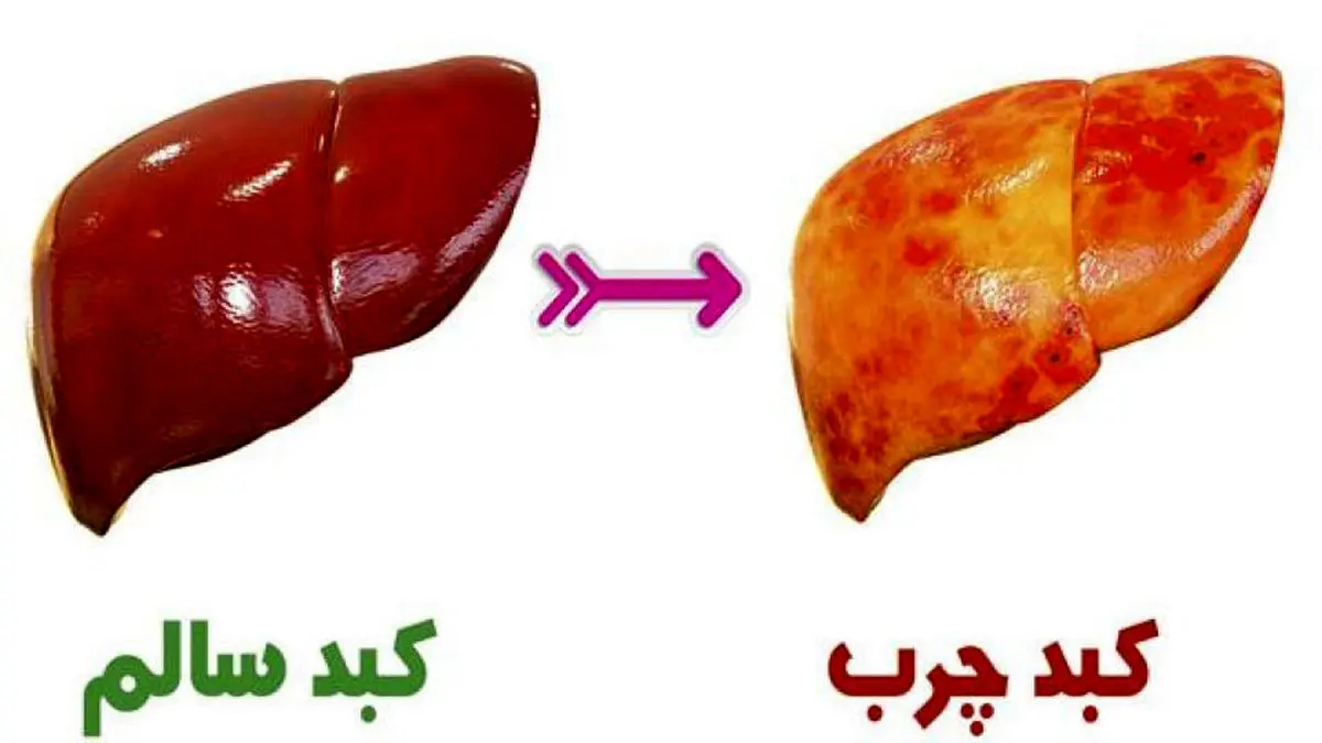 نکات مهم در تغذیه افراد مبتلا به کبد چرب