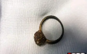 خارج کردن انگشتر بلعیده شده توسط کودک ۴ ساله سوادکوهی