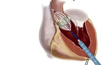 علائم تنگی دریچه آئورت