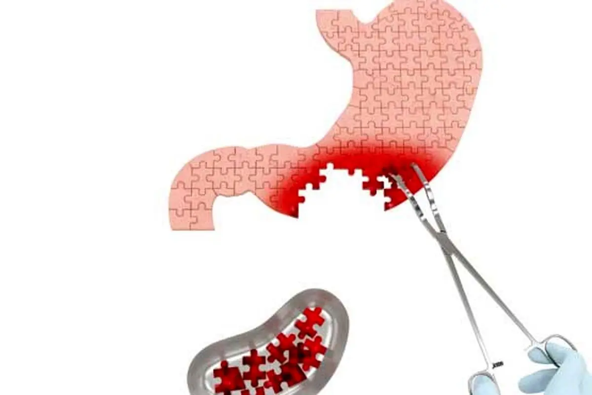 سرطان معده؛بیماری خاموش!