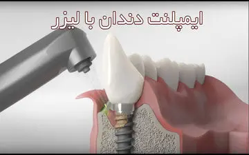 همه چیز درباره ایمپلنت دندان با لیزر