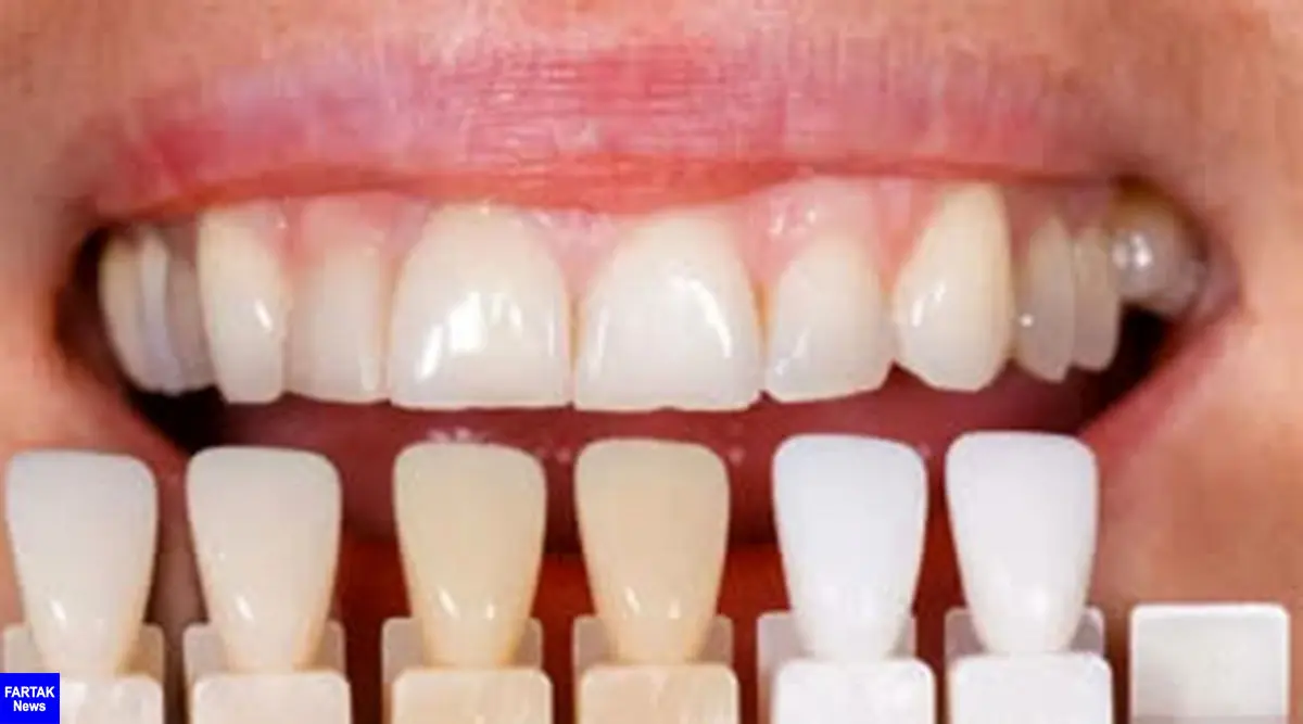 برنامه «خانواده» کانال کردی شبکه سحر؛ درباره لمینت وکامپوزیت دندان صحبت می کند