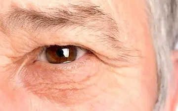 چه عواملی باعث خشکی پوست دور چشم می‌شود؟