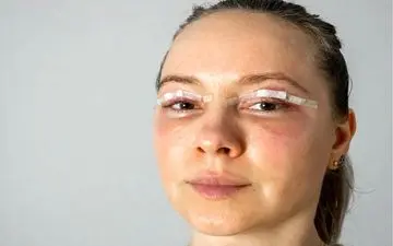 ورم بعد از بلفاروپلاستی چقدر طول میکشد؟