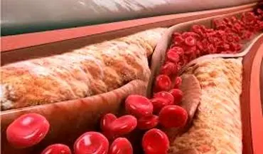 برای کنترل چربی خون  چکار کنیم؟