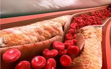 برای کنترل چربی خون  چکار کنیم؟