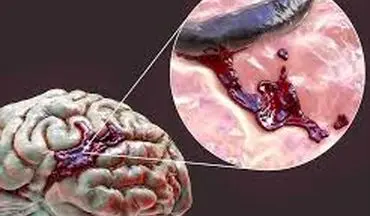 علت اصلی خونریزی مغزی چیست؟