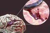 علت اصلی خونریزی مغزی چیست؟