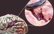علت اصلی خونریزی مغزی چیست؟