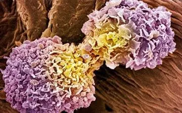 علایم فیبرو کیستیک در زنان 