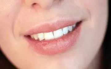  خشکی دهان؛ علل و راههای درمان آن را بدانید