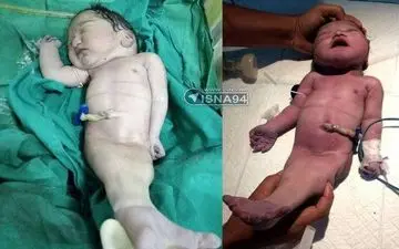 تولد کودکی در هند به شکل پری دریایی/عکس