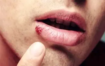 روش هایی برای درمان تبخال