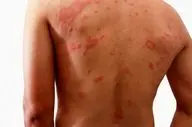 انواع کم‌خونی که می‌توانند بثورات پوستی ایجاد کنند