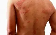 انواع کم‌خونی که می‌توانند بثورات پوستی ایجاد کنند
