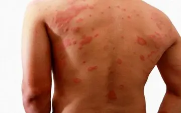 انواع کم‌خونی که می‌توانند بثورات پوستی ایجاد کنند