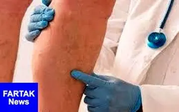 چگونه واریس را با گوجه درمان کنیم