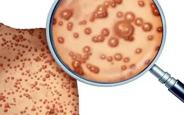 علائم آبله میمونی چه تفاوتی با آبله مرغان دارد؟