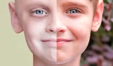 9 سرطان شایع در کودکان