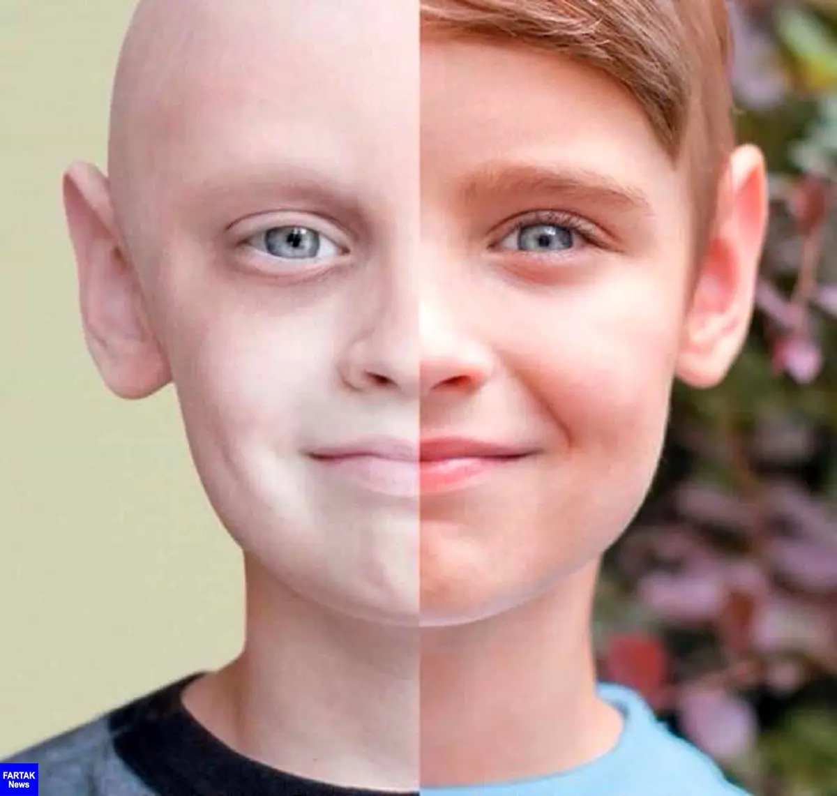9 سرطان شایع در کودکان