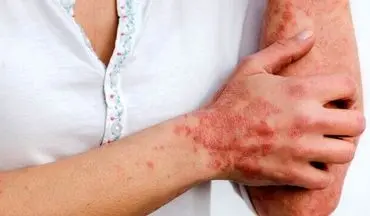  بیماری های پوست و ارتباط آن با دیابت!