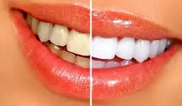 سفید کردن دندان ها با یک روش خانگی 