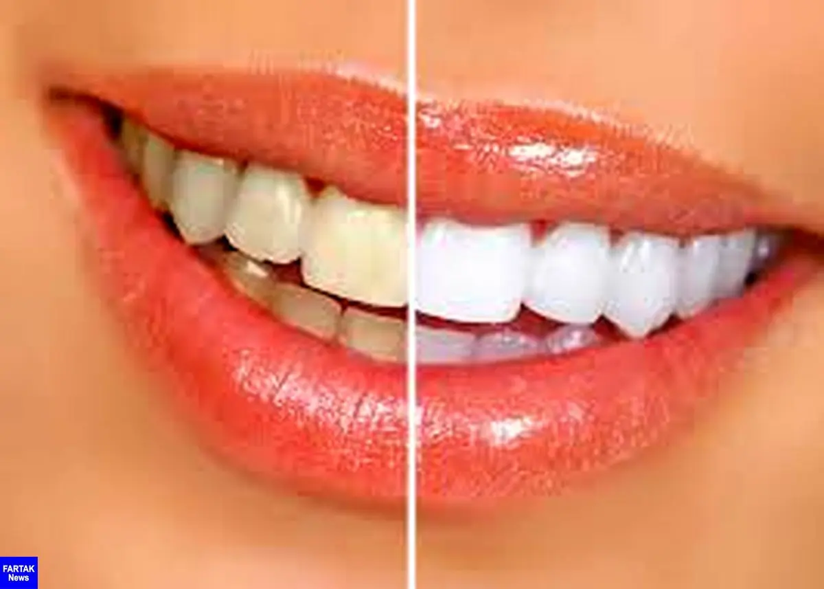سفید کردن دندان ها با یک روش خانگی 