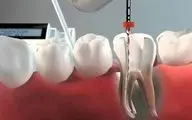 دندان‌ عصب کشی شده چند سال دوام دارد؟