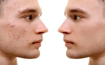 بهترین روش‌ها برای از بین بردن جوش صورت