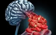  سکته مغزی چه کسانی را بیشتر تهدید می کند؟