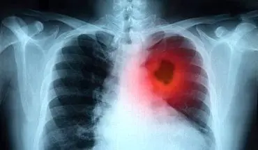 درمان سرطان ریه با استفاده از "سوزن داغ"