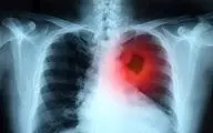 درمان سرطان ریه با استفاده از "سوزن داغ"