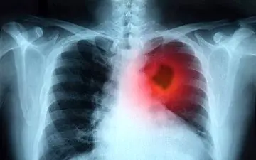 درمان سرطان ریه با استفاده از "سوزن داغ"