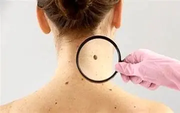 شایع‌ترین انواع سرطان پوست را بشناسید

