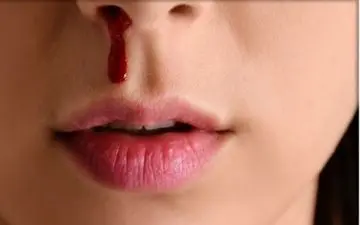 درباره بیماری فون ویلبراند چه می دانید؟

