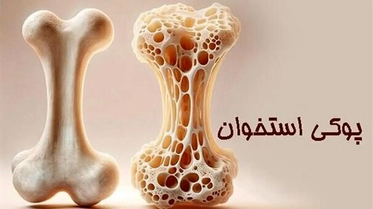 وقتی کودکان دچار پوکی  می‌شوند؛ واقعیتی که باید جدی گرفته شود