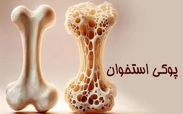 وقتی کودکان دچار پوکی  می‌شوند؛ واقعیتی که باید جدی گرفته شود