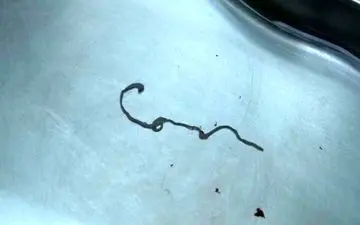 کرم انگلی که ۳۰ سال در جمجمه یک بیمار جا خوش کرده بود! 