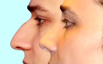 علائم قوز پشتی