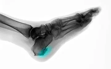 خار پاشنه چیست و چگونه درمان می‌شود؟ راهنمای کامل برای مبتلایان