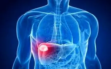 
نارسایی کبدی چیست؟+ علائم