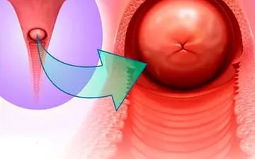 اختلالات در سرویکس رحم چیست؟انواع اختلالات در سرویکس رحم را بشناسید