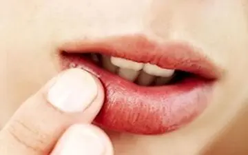  درمان سریع و آسان تبخال