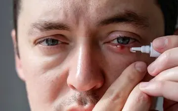 بهترین پماد چشمی برای گل مژه چشم کدام است؟