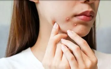 یک درمان موثر برای جوش‌های دوران بزرگسالی

